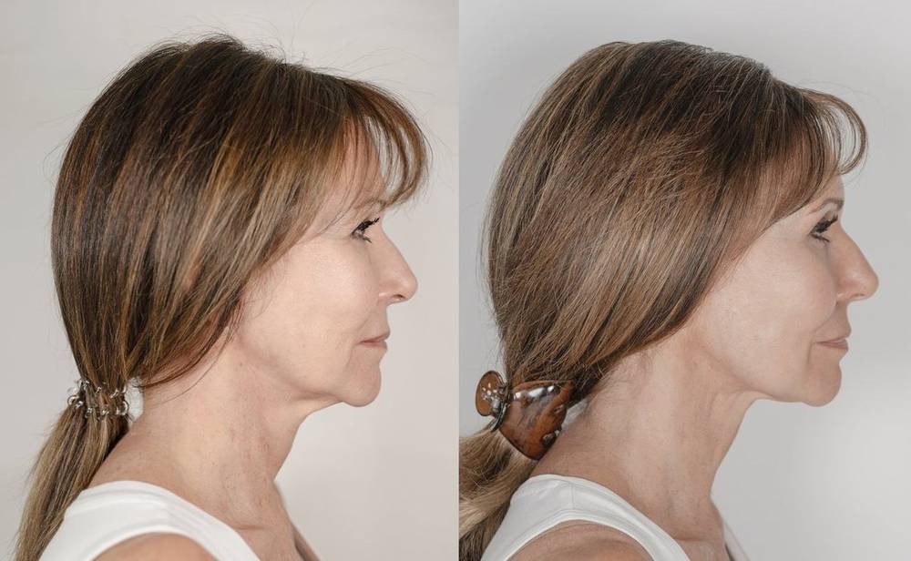 Linda Lusardi — NeoGen plasma before and after, profile
