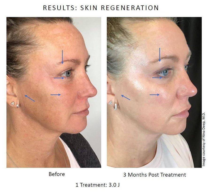 NeoGen skin regeneration — face and neck before & after — 3 months post treatment 3.0J