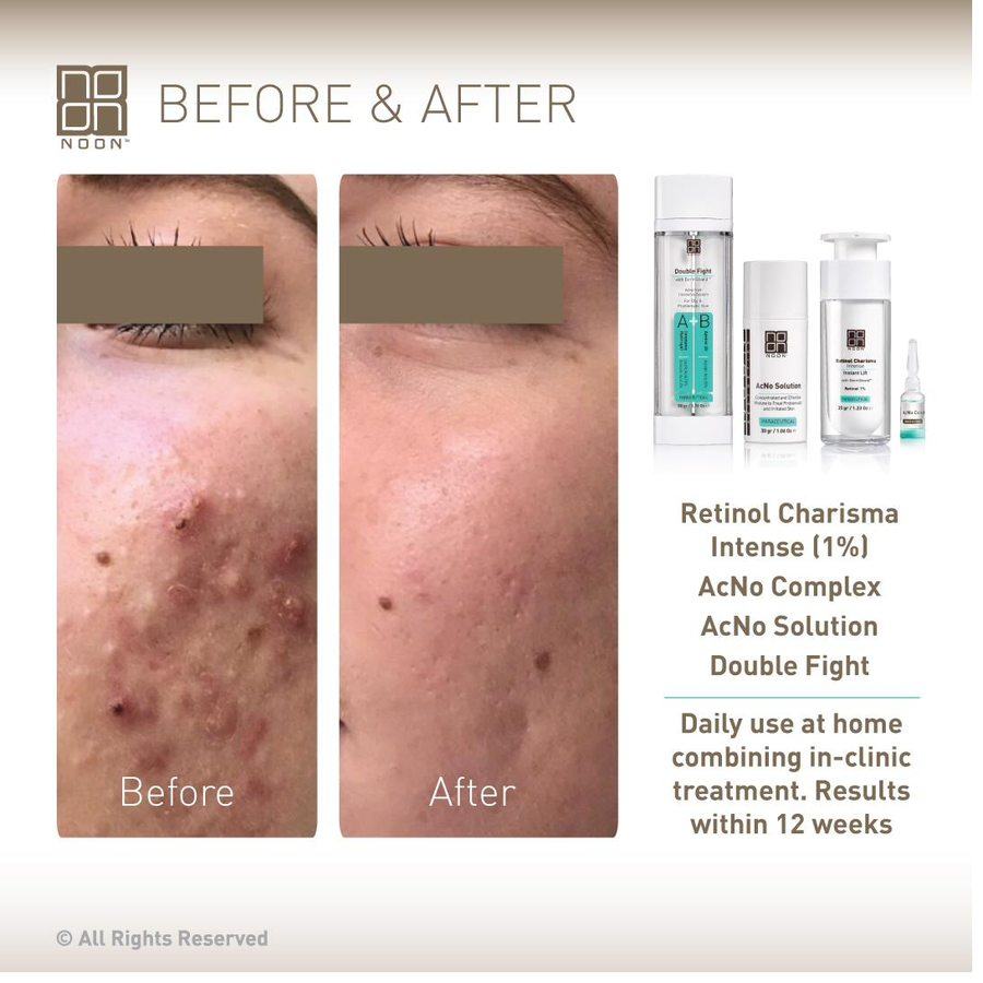 NOON before and after — acne scarring 12 weeks