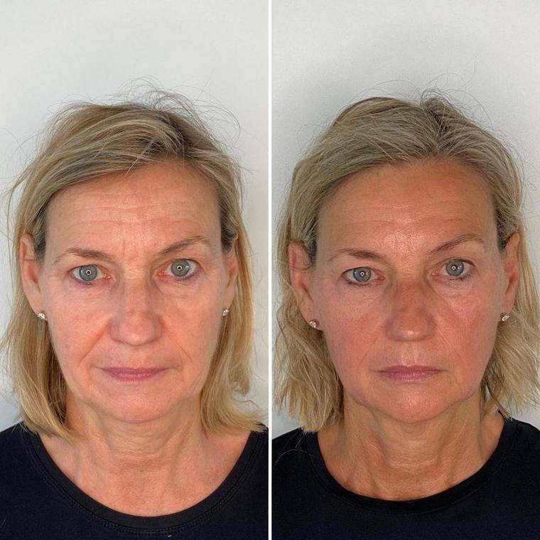 Before and after