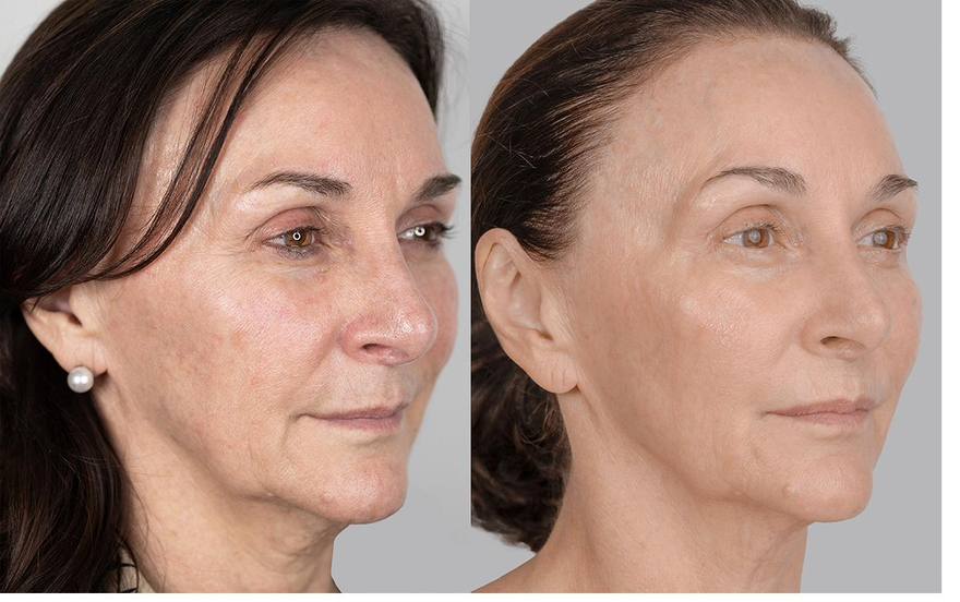 Shirley Ballas — NeoGen plasma before and after, three-quarter