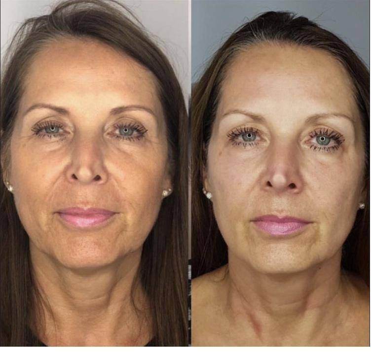 Before and after