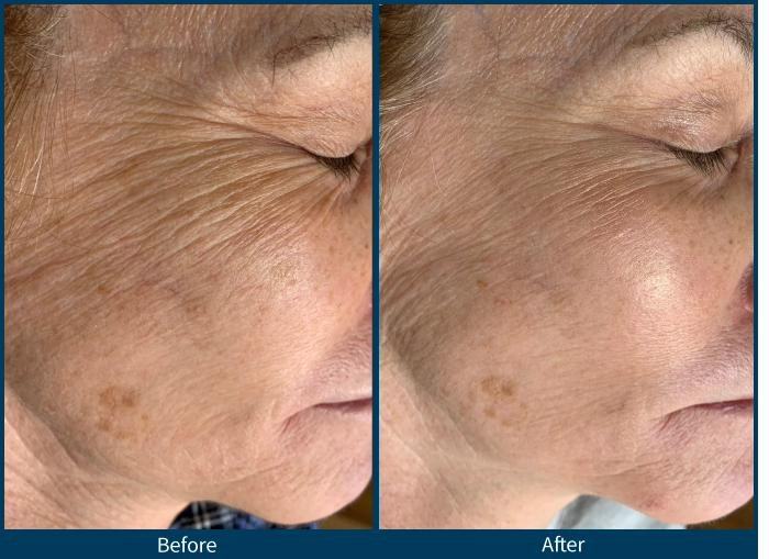 SkinPen — face rejuvenation 1 treatment