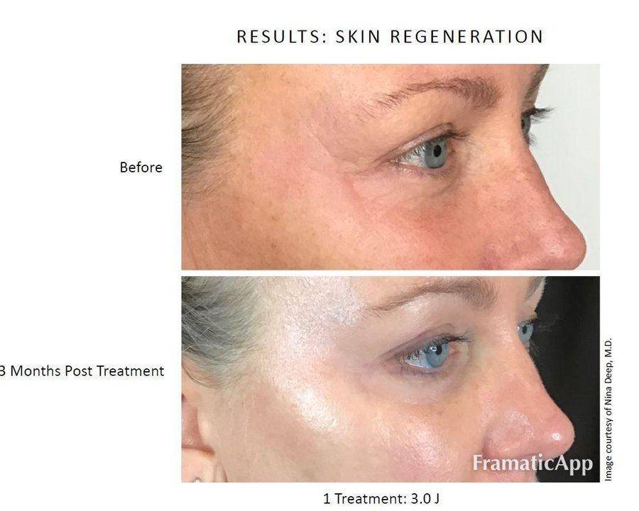 NeoGen periorbital regeneration — eyes before & after
