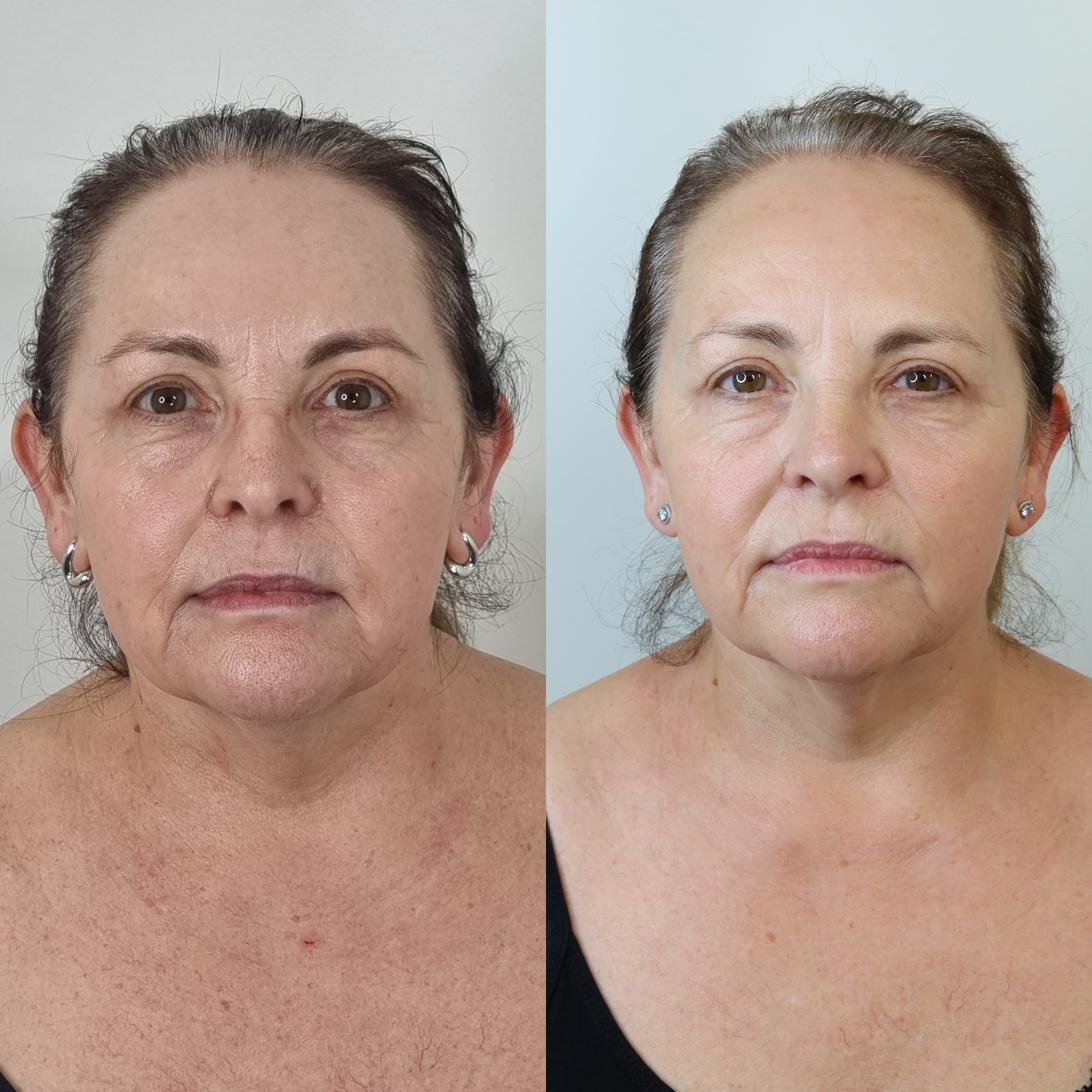 Before & After