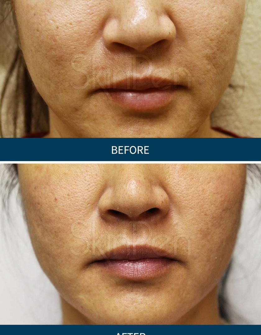 SkinPen — skin regeneration 3 treatments