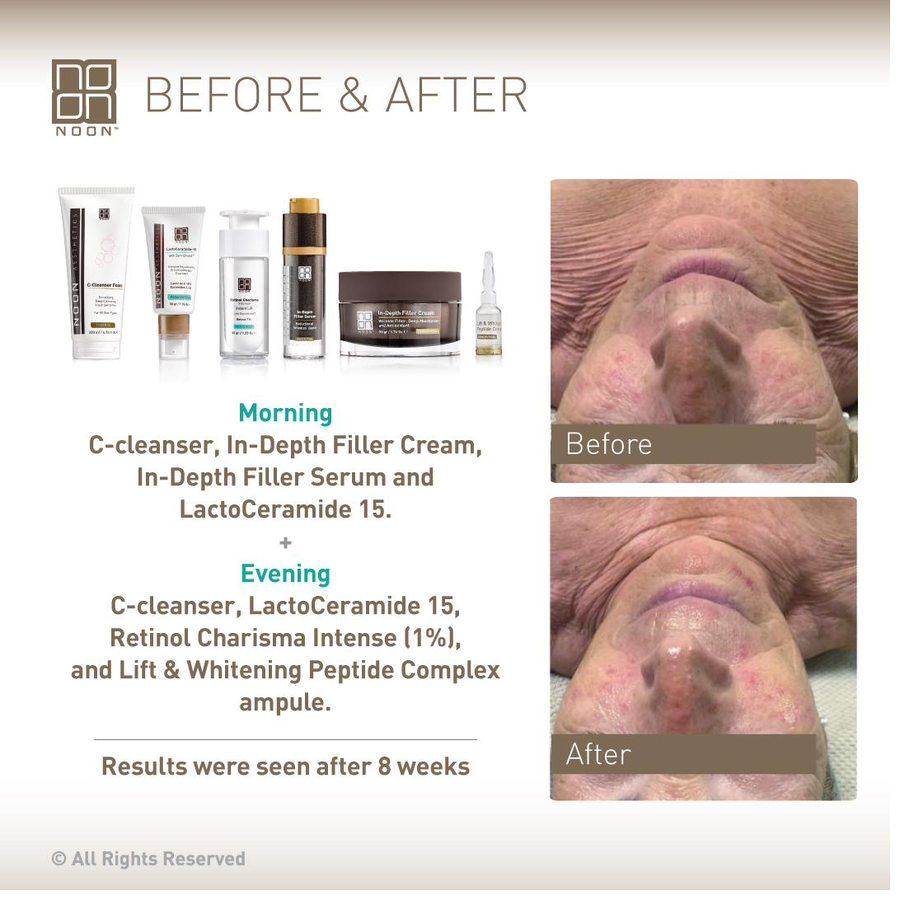 NOON before and after — mature skin 8 weeks