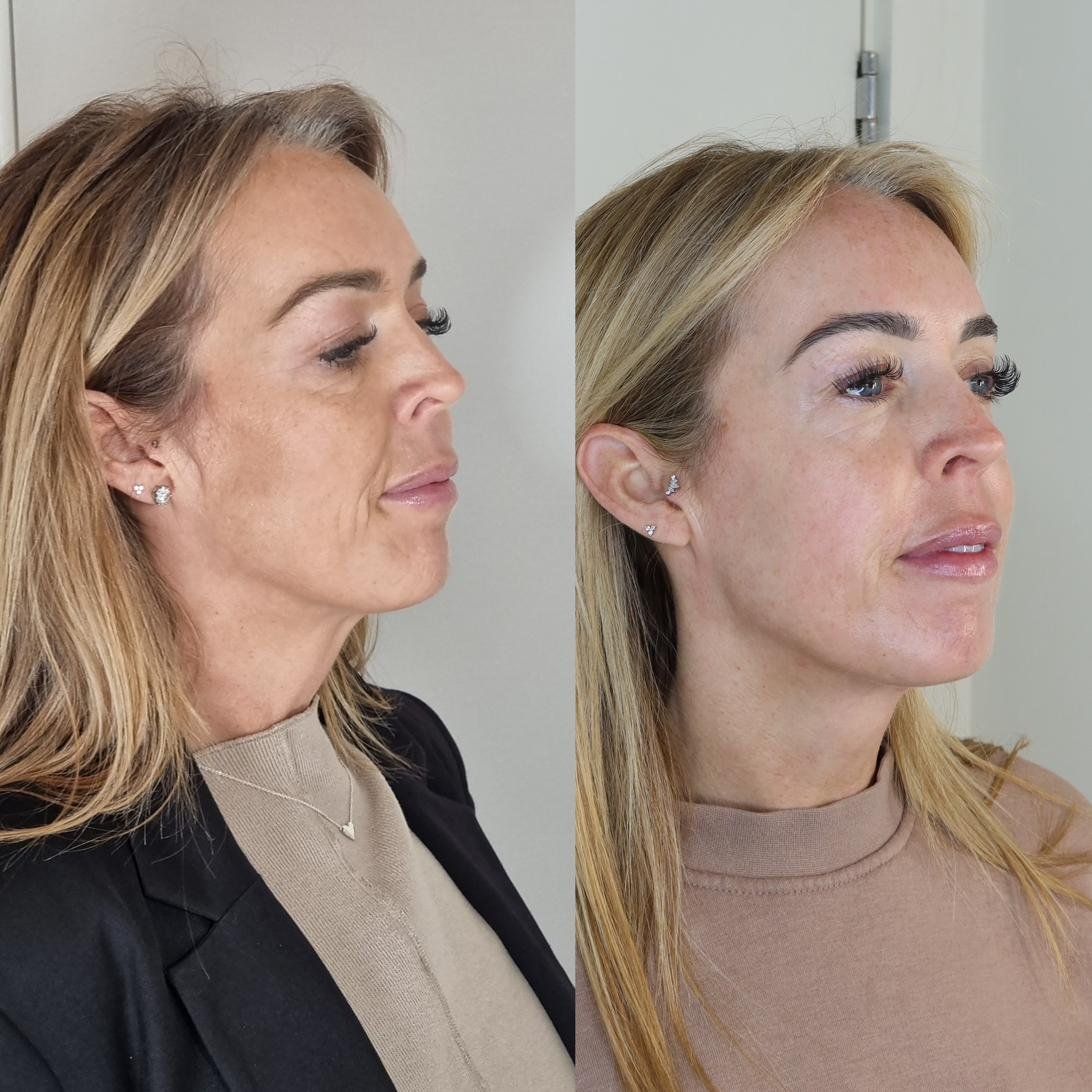 Before & After