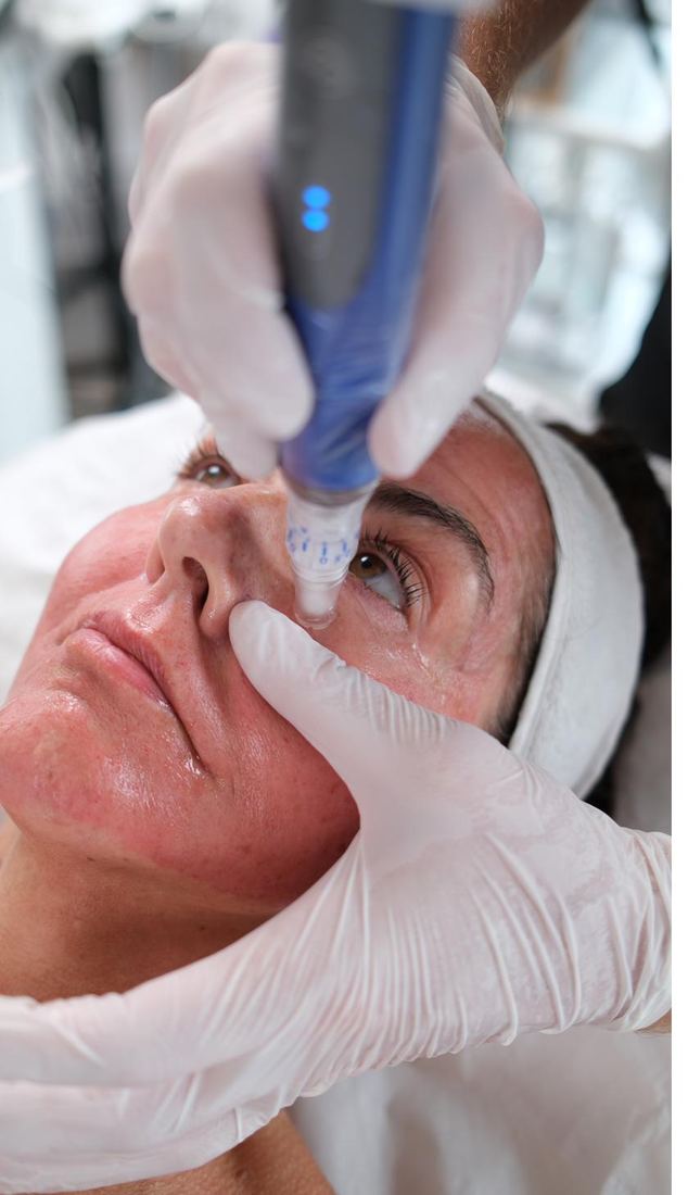 SkinPen microneedling treatment